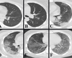 Predicting COVID-19 Outcomes: Machine Learning Predictions Across Diverse Datasets – Cureus