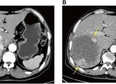 Prediction of initial objective response to drug-eluting beads transcatheter arterial chemoembolization for hepatocellular carcinoma using CT radiomics-based machine learning model