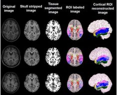 Automated detection of MRI-negative temporal lobe epilepsy with ROI-based morphometric features and machine learning