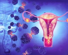 Machine Learning–Based Classifier Accurately Identifies Ovarian Cancer