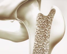 Machine learning predicts osteoporosis in patients with rheumatoid arthritis