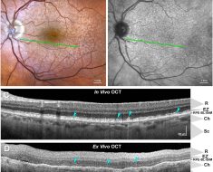 Study uses new tools, machine learning to investigate major cause of blindness in older adults